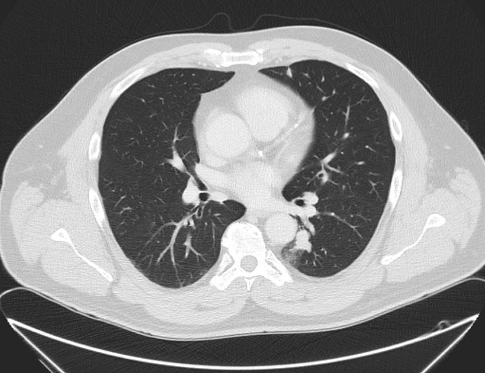 Temple Lung Center Magazine Spring 2024 UNDERDIAGNOSIS OF
